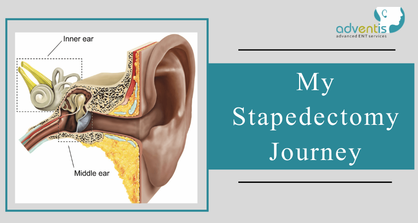 Otosclerosis and stapes surgery — Hearing Institute