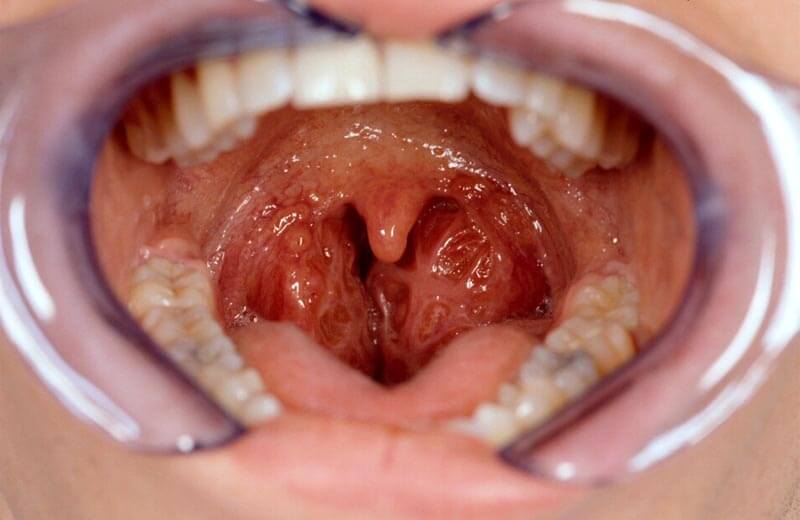 Tonsils - huge