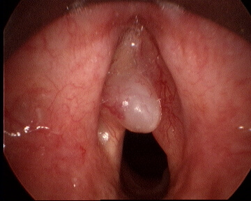 VC Polyp Pre
