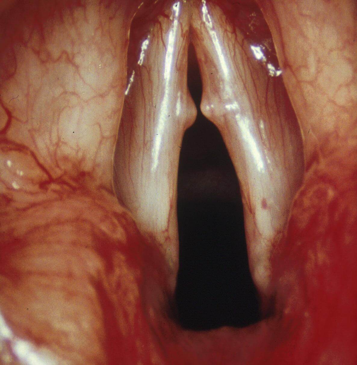 Vocal Nodules