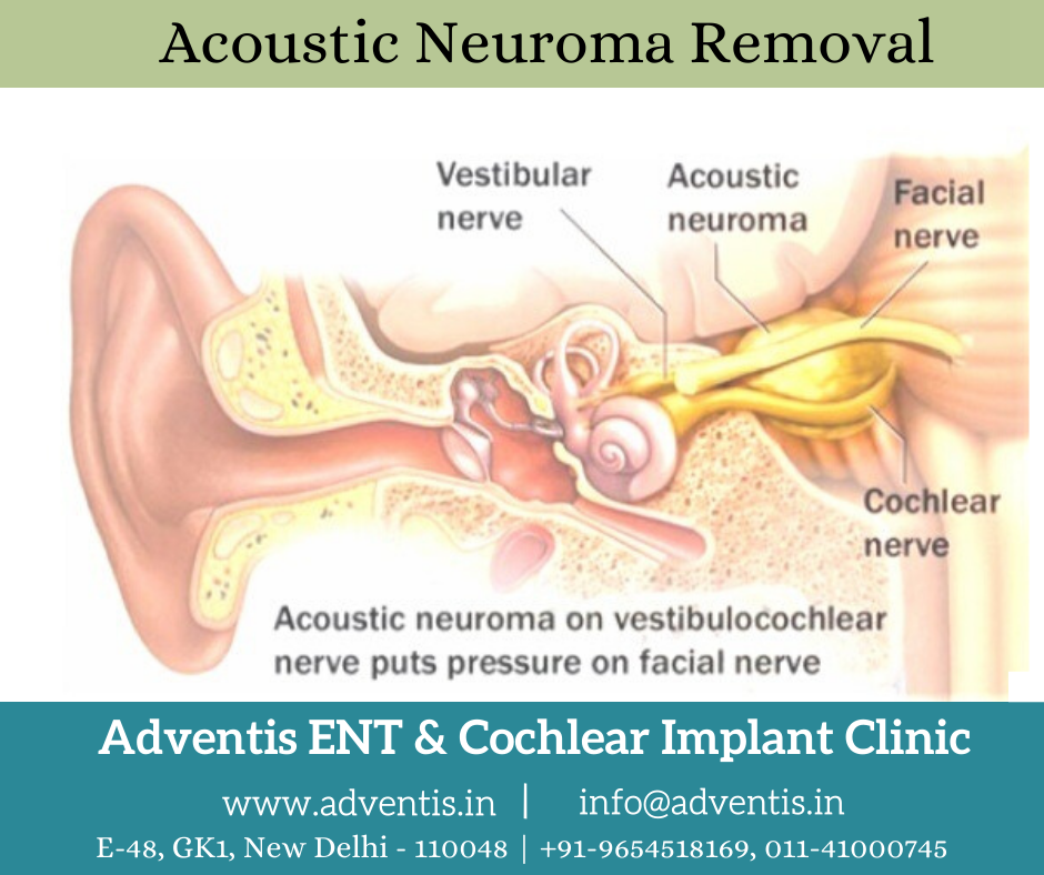 Acoustic Neuroma Removal Treatment, Surgery & Cost Adventis