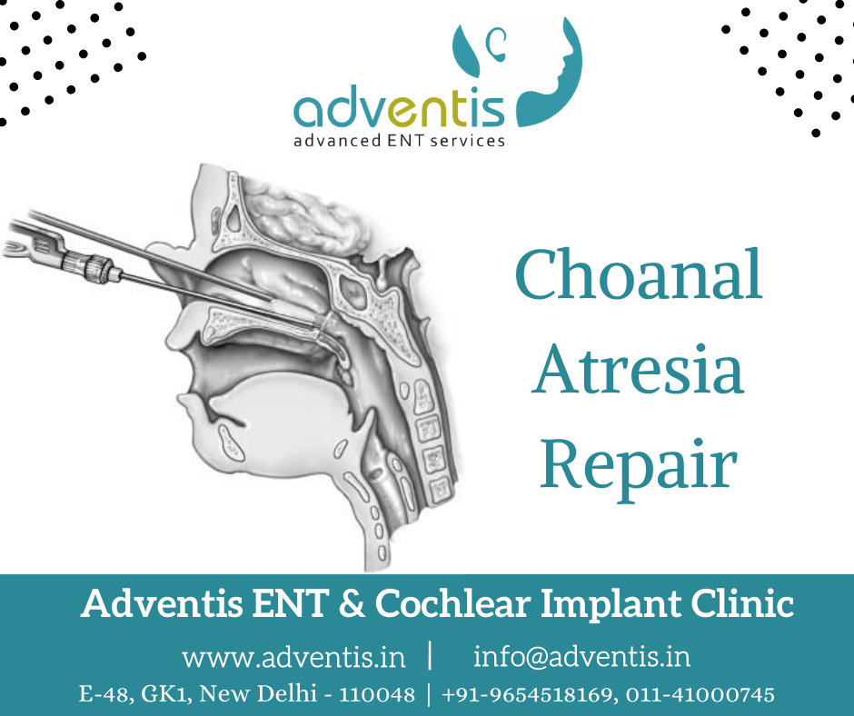 Children Choanal Atresia Repair Treatment in Delhi | Adventis