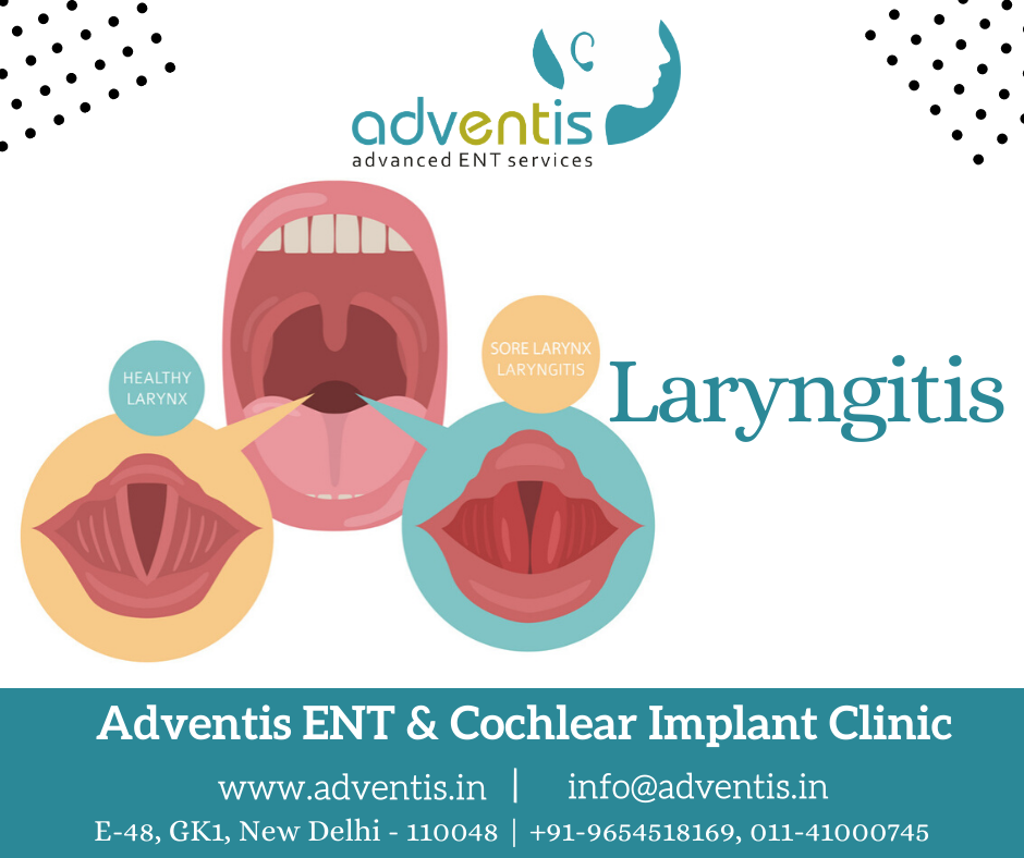 Laryngitis, chronic laryngitis, Acute Laryngitis Treatment in Delhi