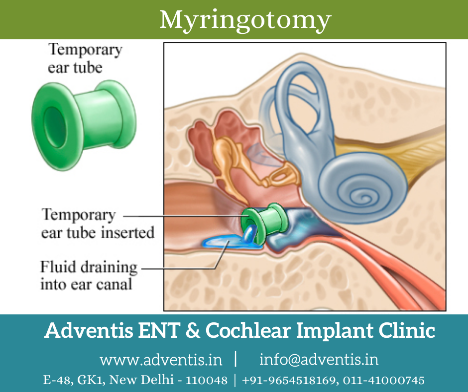 Ventilation tubes (grommets) for otitis media with effusion (OME