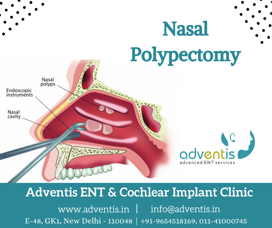 Nasal Polypectomy Treatment in Delhi Surgery & Cost Adventis