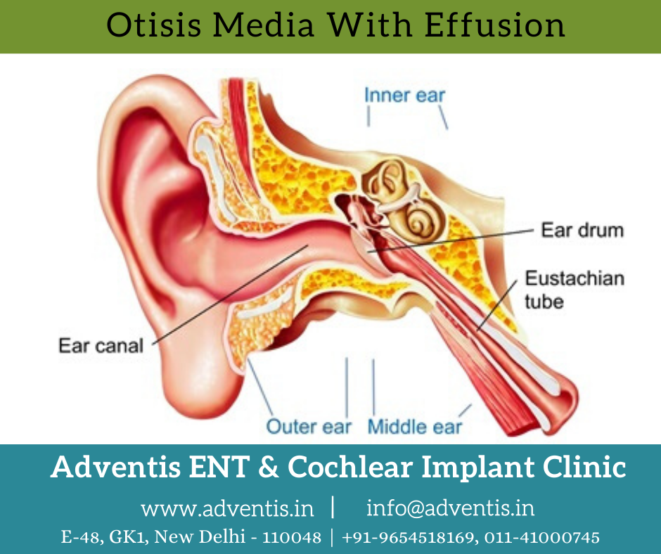 Ventilation tubes (grommets) for otitis media with effusion (OME