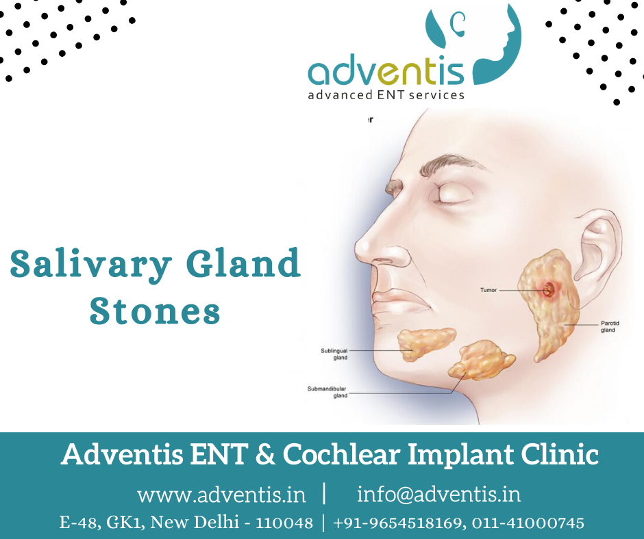 Salivary Gland Stones in Delhi Treatment, Surgery, Cost Adventis