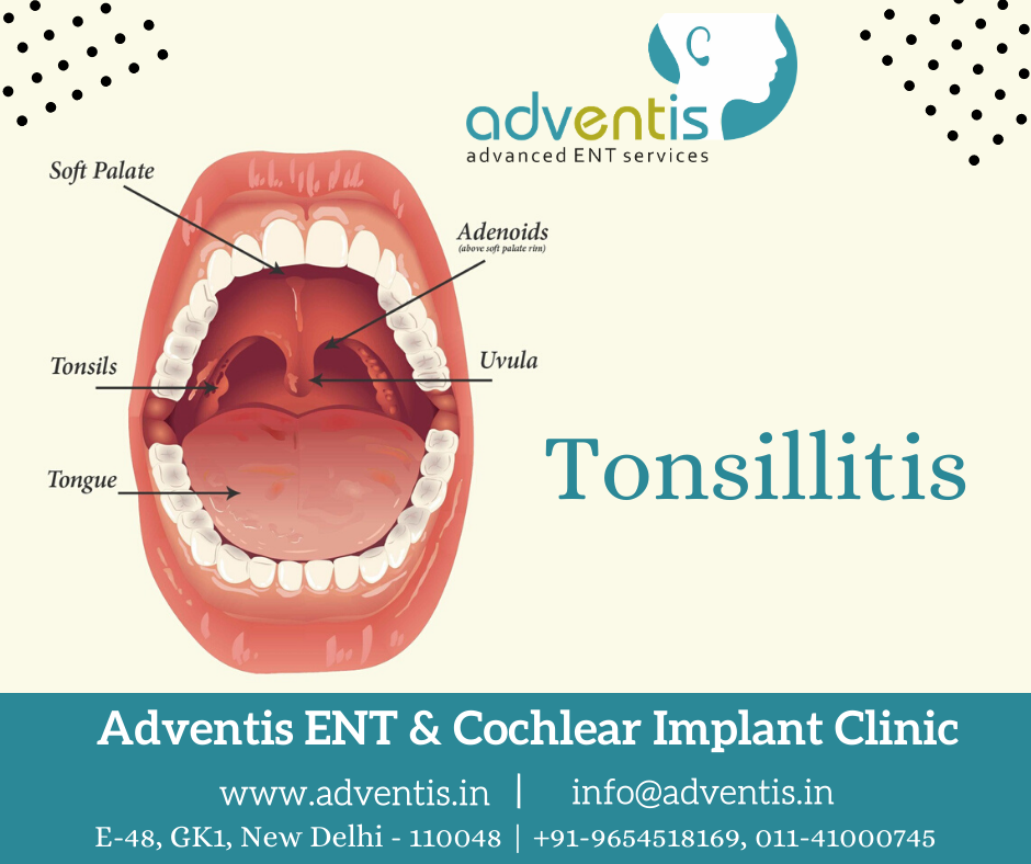 Tonsillitis Infection of Tonsils Treatment in Delhi Adventis