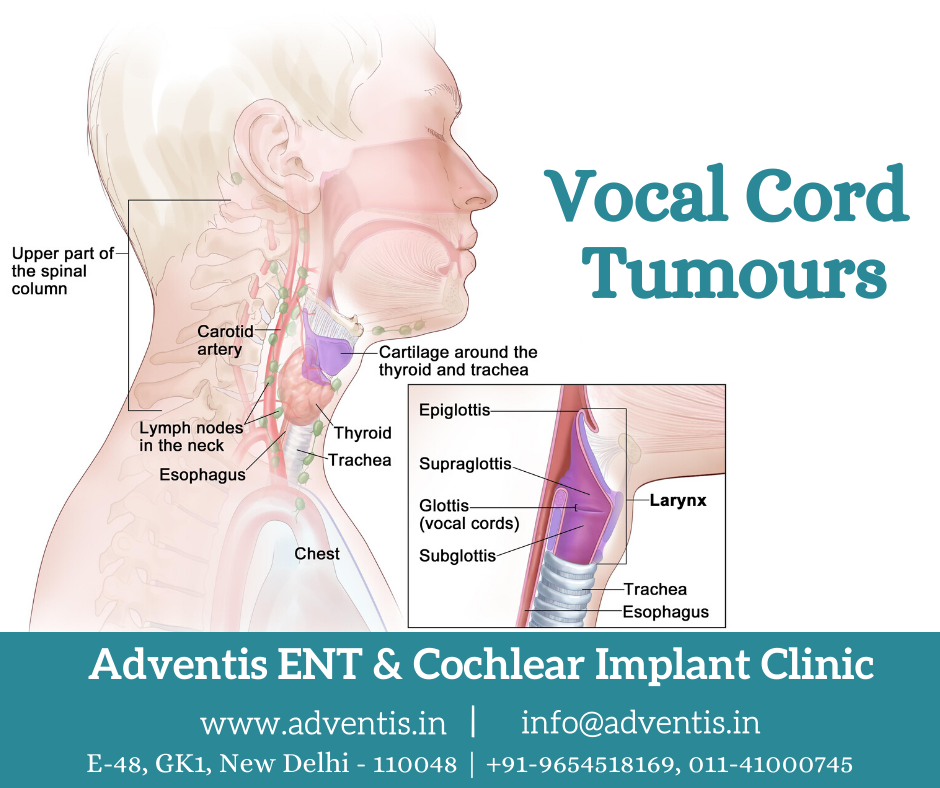 Vocal Cord Tumours Removal, Cancer Treatment in Delhi Adventis
