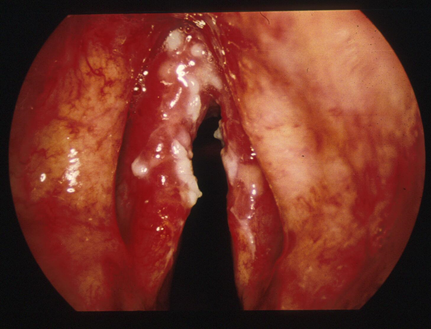 First signs of throat cancer pictures