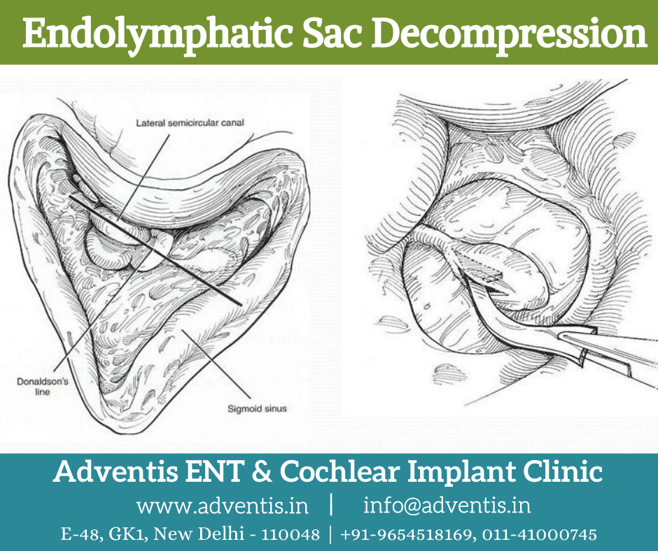 Best Endolymphatic Sac Decompression Surgery in Delhi | Adventis