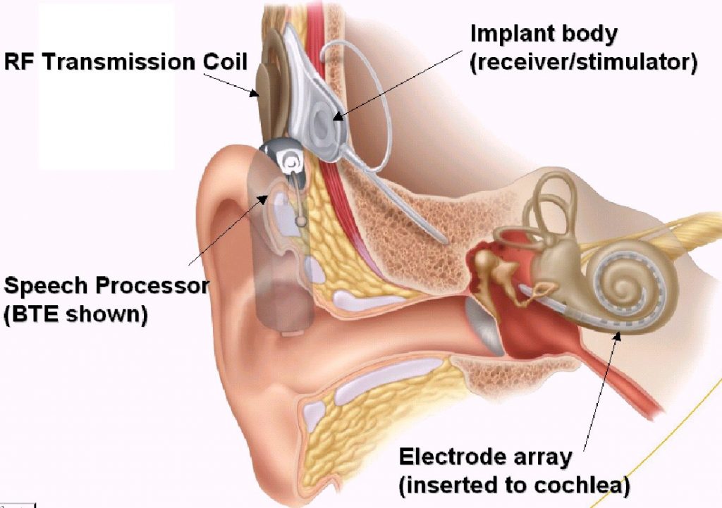 Cochlear Implants Map