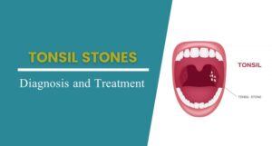 Tonsil Stones : Signs, Causes, Symptoms &amp; Its Treatment | Adventis