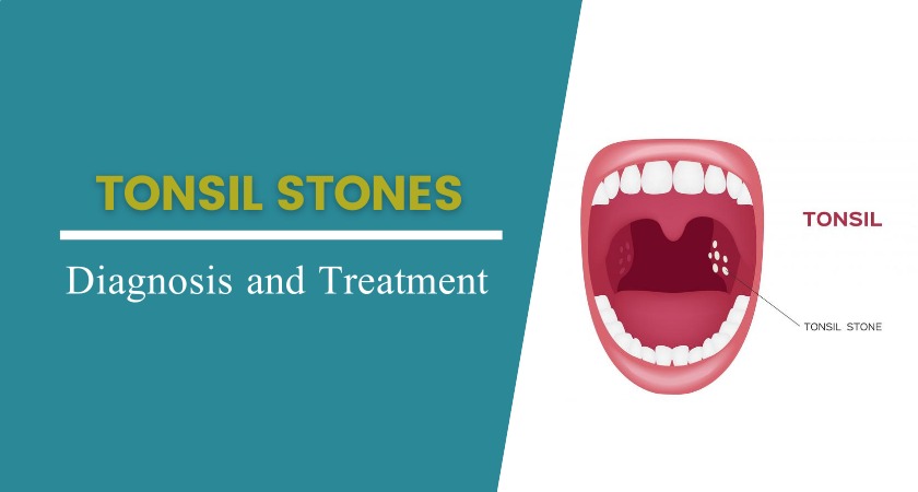 tonsil stones