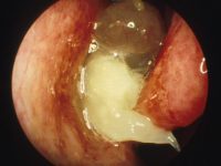 Aggressive Diffuse Nasal Polyps