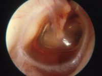 Glue ear