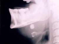 Submand Gland Calculus