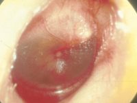 Acute Otitis Media