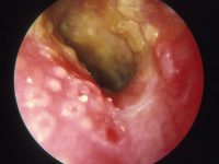 ear infection (otitis externa)
