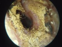 fungal otitis externa