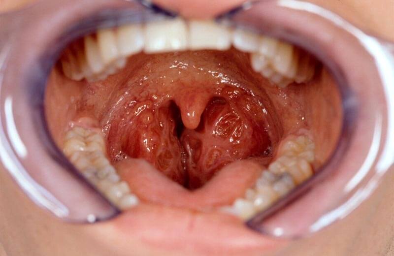 Tonsils - huge