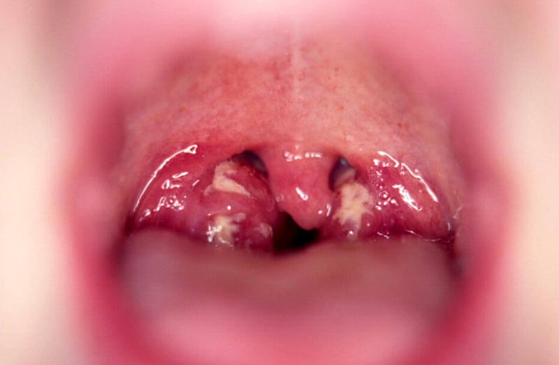 Tonsillitis IM