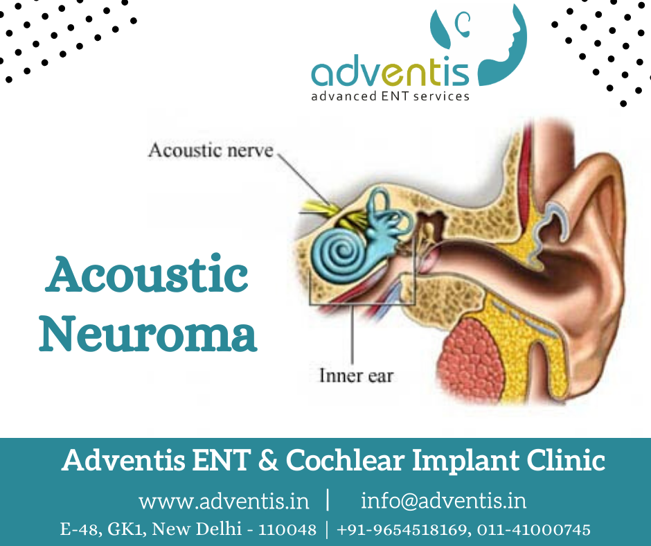 Acoustic Neuroma Treatment & Surgery in Delhi Adventis