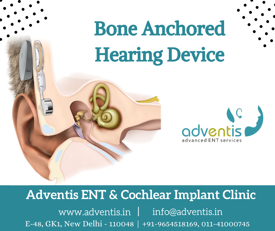 Best Bone Anchored Hearing Device Treatment BAHA Surgery in Delhi