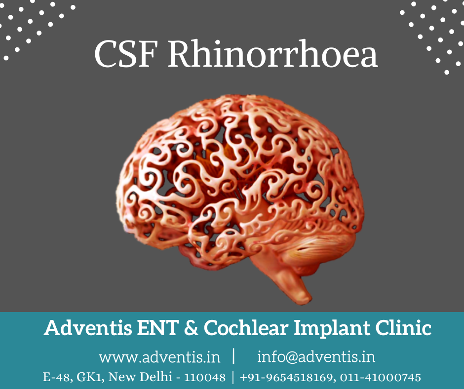 Best CSF (Cerebrospinal Fluid) Rhinorrhoea Treatment in Delhi, Surgery