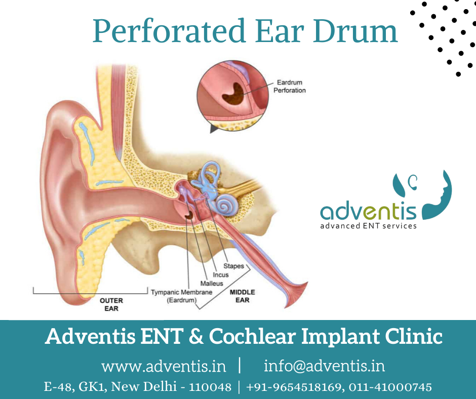 Perforated Ear Drum Infection Treatment in Delhi, India Adventis