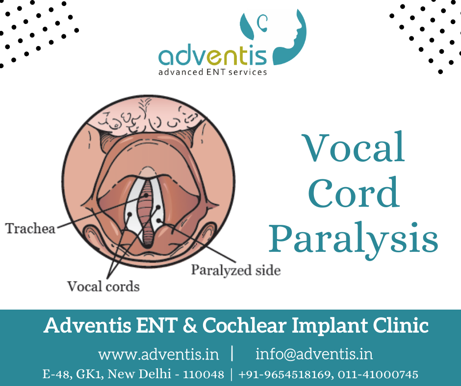 Vocal Cord Paralysis Treatment in Delhi Surgery & Cost Adventis