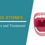 Tonsil Stones and Its Treatment