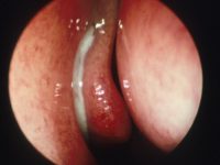 Acute Maxillary Sinusitis