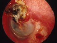 Cholesteatoma Cholesteatoma