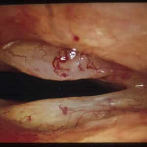 Chronic - Laryngitis