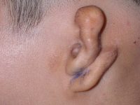 Microtia