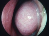 Swollen L Inferior Turbinate