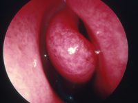 Viral Rhinitis