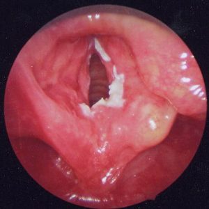 Laryngitis - Fungal