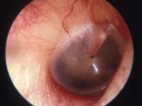 Ear Drum